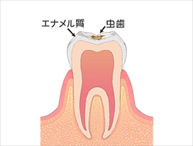 C0～C1（初期段階の虫歯）